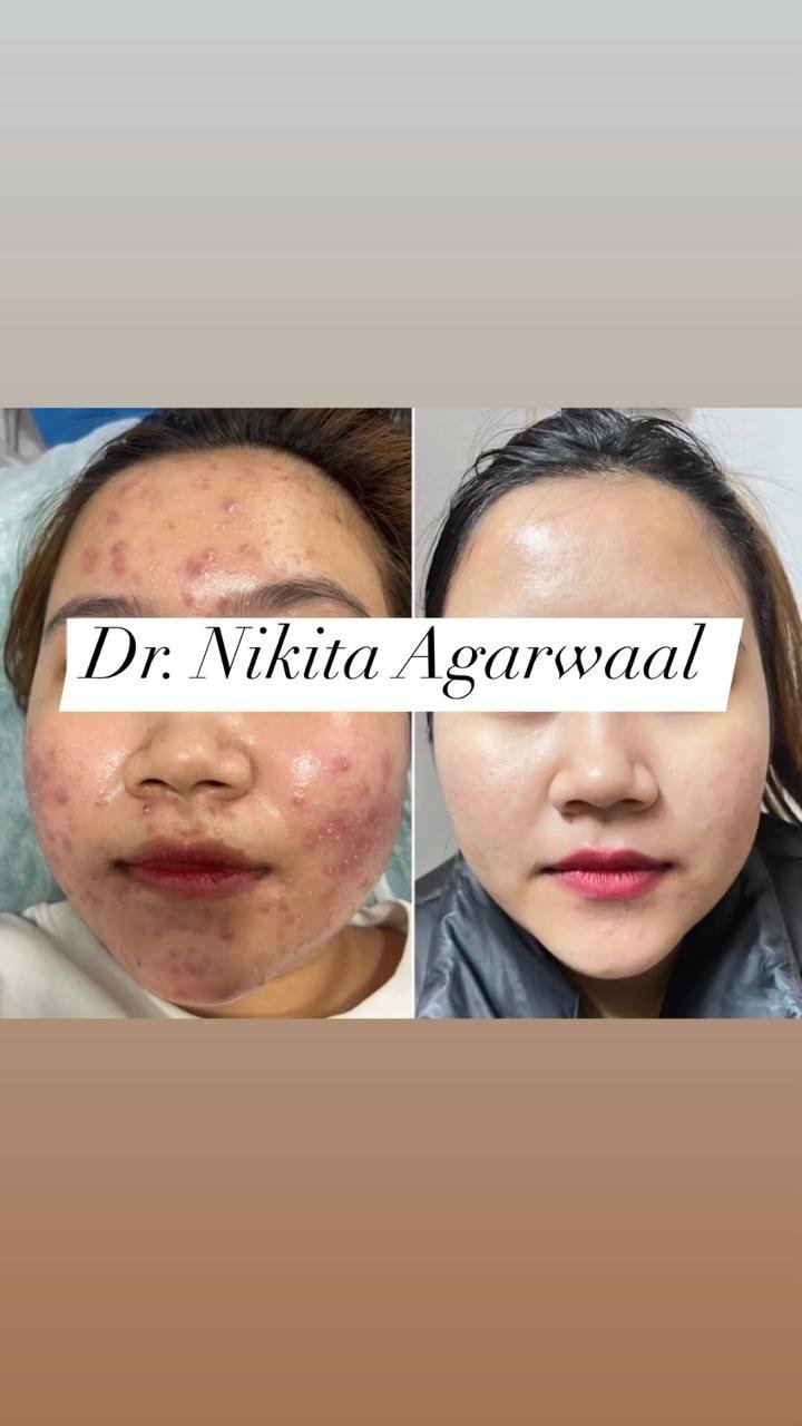 Advanced skin treatment